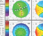 Anisometropia and a Unilateral Congenital Cataract