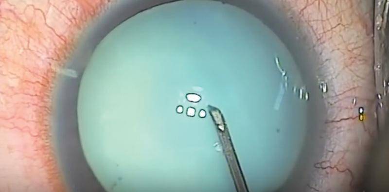 I Dont Have a Femtosecond Laser What Strategies Work Best for a White Cataract