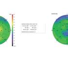 Epithelial Thickness Mapping for the Detection and Management of Corneal Irregularities