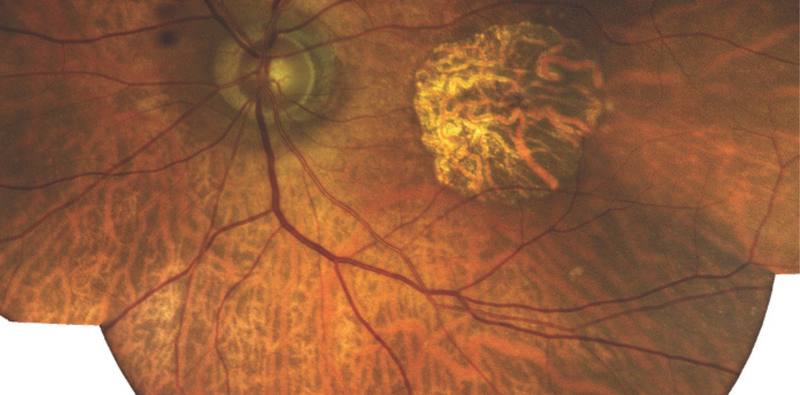 More Than 20 Radial Keratotomy Incisions