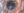 Figure 1. Blood is visible in the angle.Courtesy of Dean P. Ouano, MD
