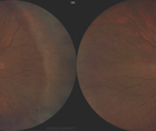 Cataract Surgery in Eyes With Retinal Pathology