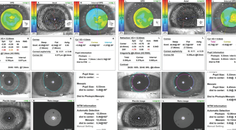 Decreased Vision From Thygeson Superficial Punctate Keratitis