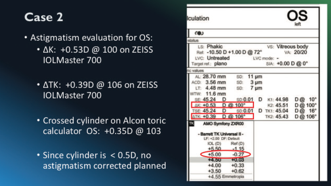 Best Practices in IOL Calculations