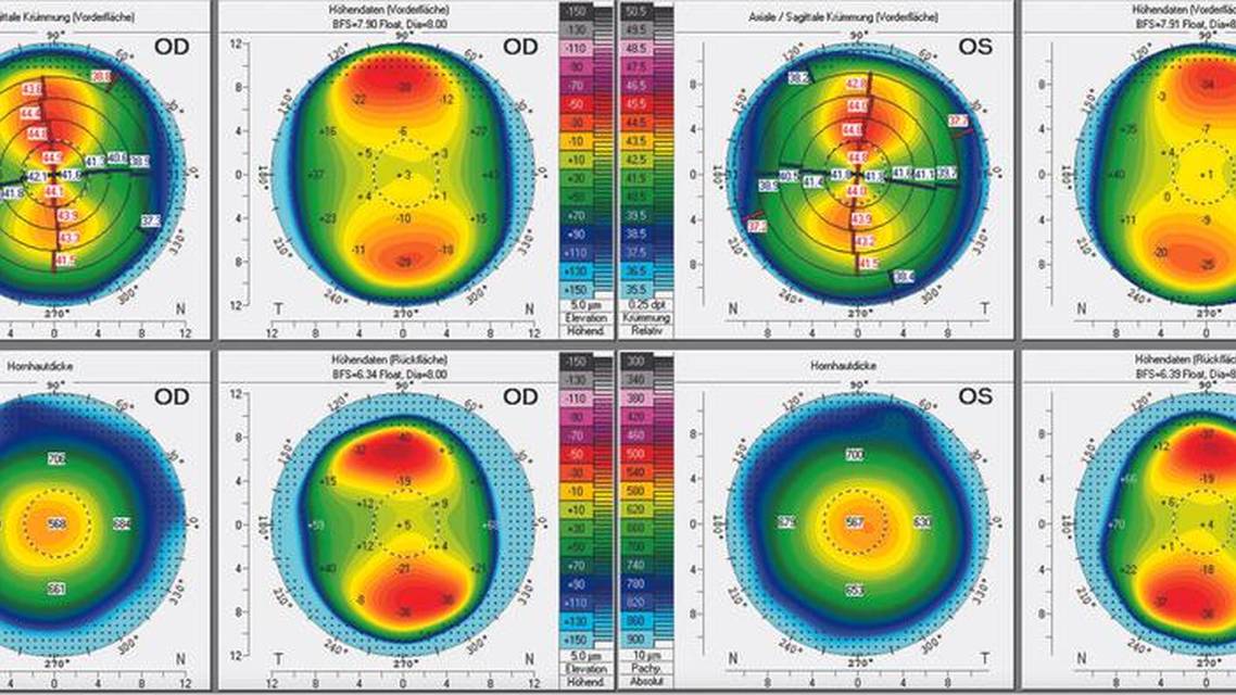 High Myopic Astigmatism