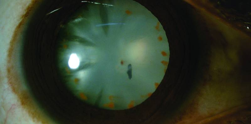 Intralenticular Iron Foreign Body With Lens Siderosis