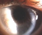Refractive Treatment Options After Radial Keratotomy