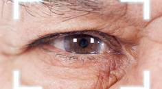 Radial Keratotomy and Salzmann Nodular Degeneration
