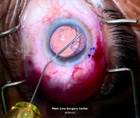 Prolene Suture Fixation of Capsular Tension Segment During Lens Exchange thumbnail
