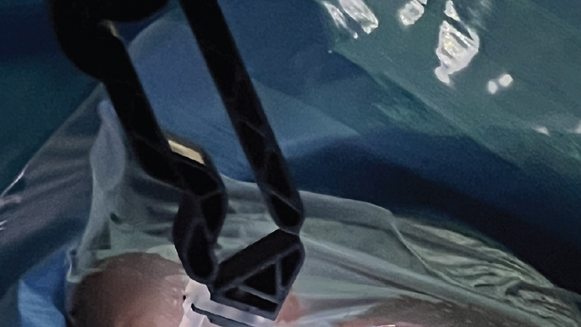 How GONIO ready Can Help Surgeons Maximize the Potential of MIGS