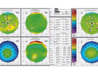 Persistently Blurred Vision After LASIK