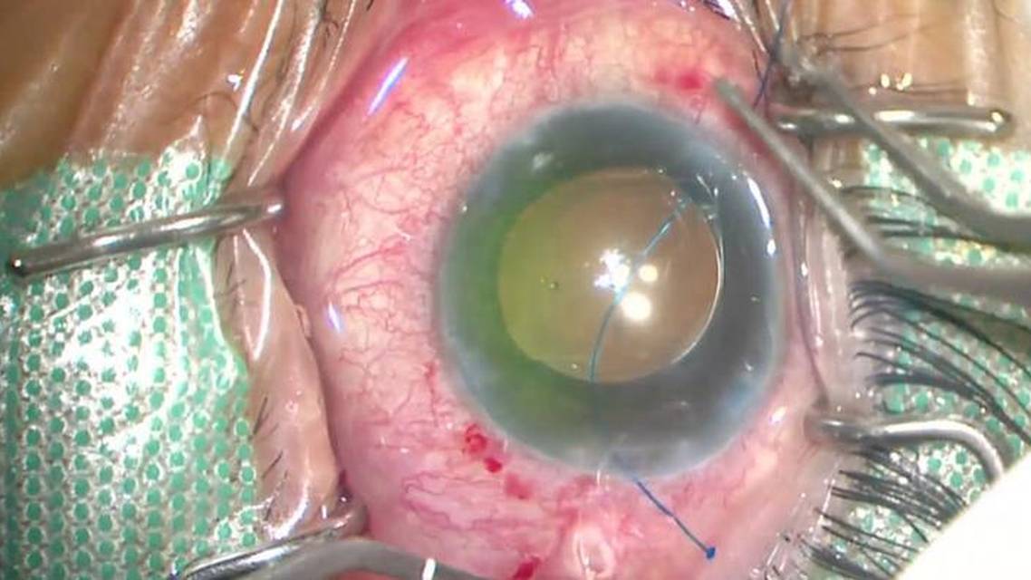 Flanged Technique for Capsular Tension Segment Fixation