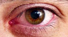Treating Dry Eye Associated With Meibomian Gland Dysfunction