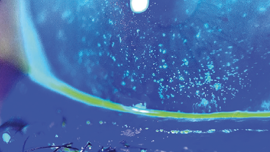 Freeze Dried Amniotic Membrane for Filamentary Keratitis