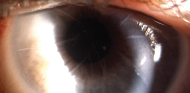 Cataract Surgery After Prior Radial Keratotomy