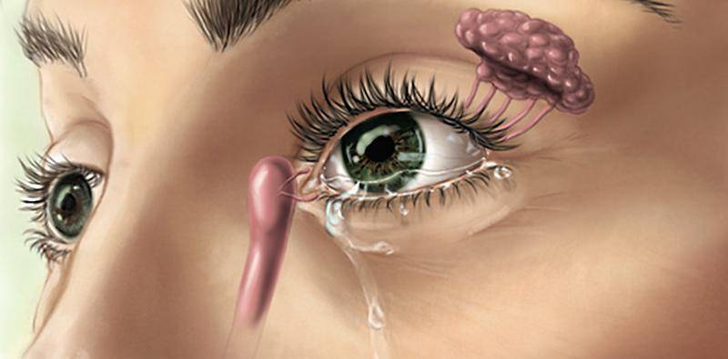 Neurostimulation Offers New Approach to Dry Eye