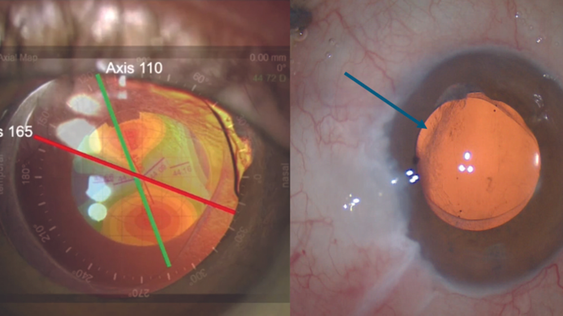IOL Exchange With a Light Adjustable Lens