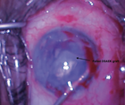 Repeat DSAEK in a Completely Dislocated Failed DSAEK Graft Adhered 360 Degrees to the Iris