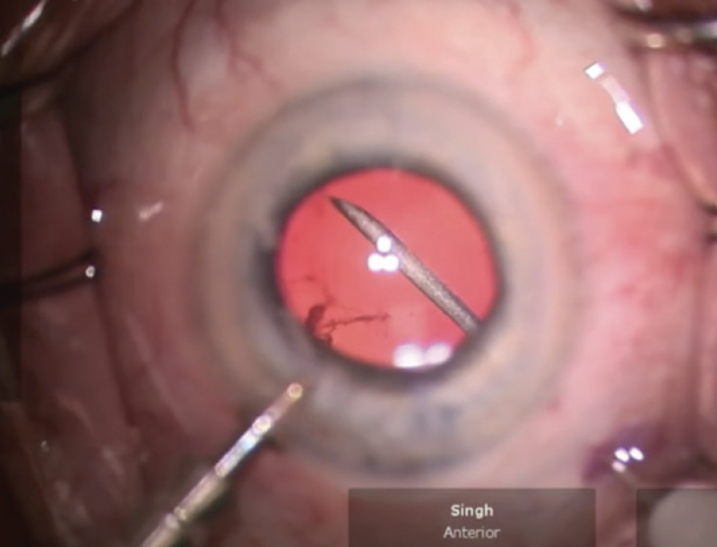 Clinically Significant Vitreous Opacities