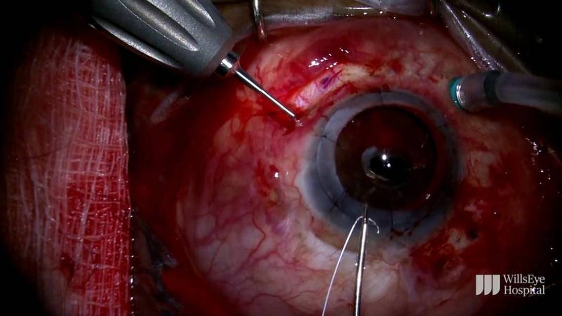 A Complex Case of Cornea Transplant and IOL Exchange thumbnail