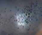 Corneal Changes After IOL Exchange