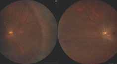 Cataract Surgery in Eyes With Retinal Pathology