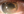 Figure. Corneal edema inferiorly and optic capture of a three-piece IOL, the inferior haptic of which is in the anterior chamber.