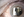Figure 1. Cataract and RK incisions in the left eye.