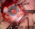GoreTex Sutured Envista Envy thumbnail