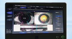 CALLISTO eye Versus Intraoperative Aberrometry