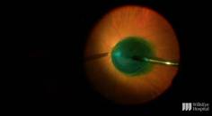 Guidance on Repairing a Macular Hole thumbnail