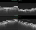New Software Study GA AMD Quantification