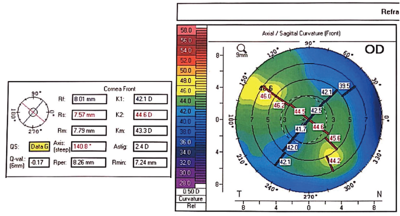 Cataract and Glaucoma After Penetrating Keratoplasty