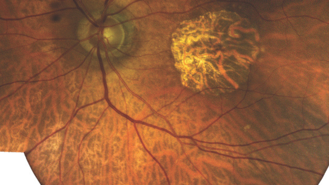 More Than 20 Radial Keratotomy Incisions