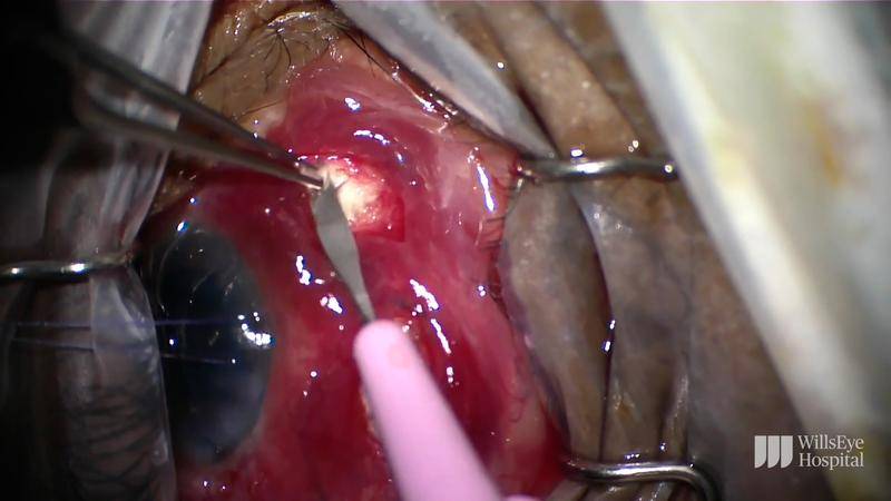 Choroidal Effusion Drainage and Cataract Removal thumbnail