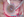 Figure 1. A 2.85-mm angle blade is used to create an incision in the temporal cornea under an infusion of balanced salt solution.