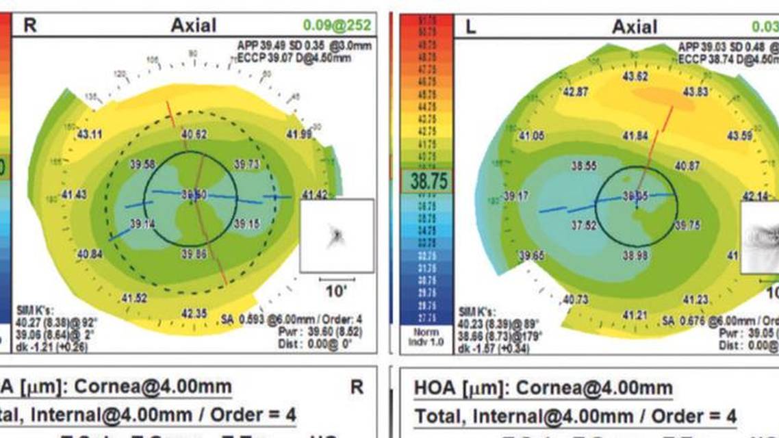 Is This the Perfect Candidate for Refractive Surgery