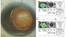 Ectopia Lentis