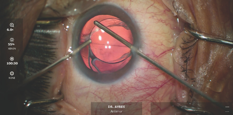 Postoperative Anisometropia