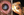 Figure 1. A 32-year-old man presented with a mature white cataract from an Acacia thorn injury to the left eye that penetrated the cornea, iris, and anterior and posterior capsular bags (A). Surgery without access to vitrectomy resulted in normal pupil contour, placement of a posterior chamber IOL, and restoration of vision (B).