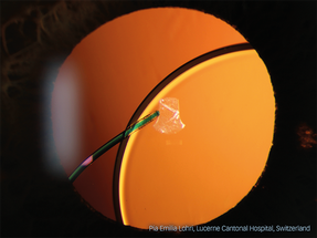 Haag-Streit Announces Winners of its Slit Lamp Imaging Competition 2023 image