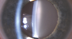 Calcification of Hydrophilic Acrylic IOLs
