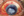 Figure 2. Residual lens fragment in the anterior chamber and corneal edema.