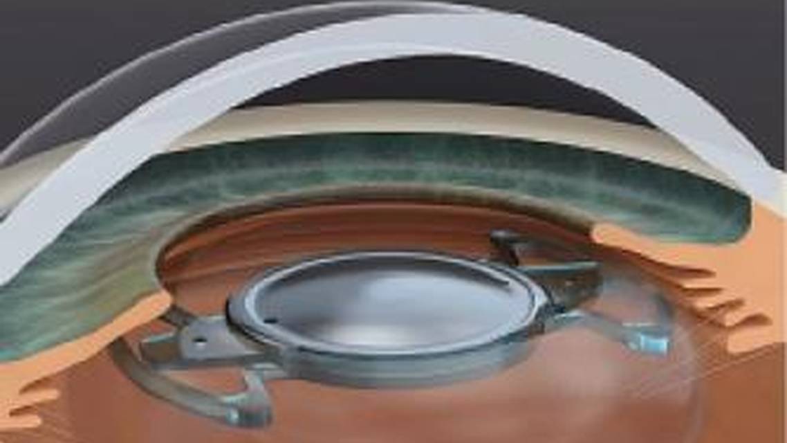 Precisight Multicomponent IOL