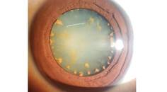 Ocular Siderosis Without a Detectable Intraocular Foreign Body