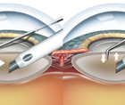 A History of Phaco Chop