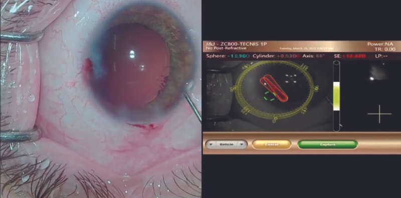 IOL Exchange in an Eye With Silicone Oil