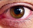 Treating Dry Eye Associated With Meibomian Gland Dysfunction