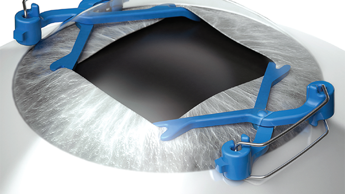 Cataract Surgery in Small Pupils