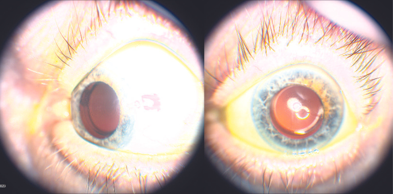 Premium IOL in an Eye With a History of Lattice Corneal Dystrophy